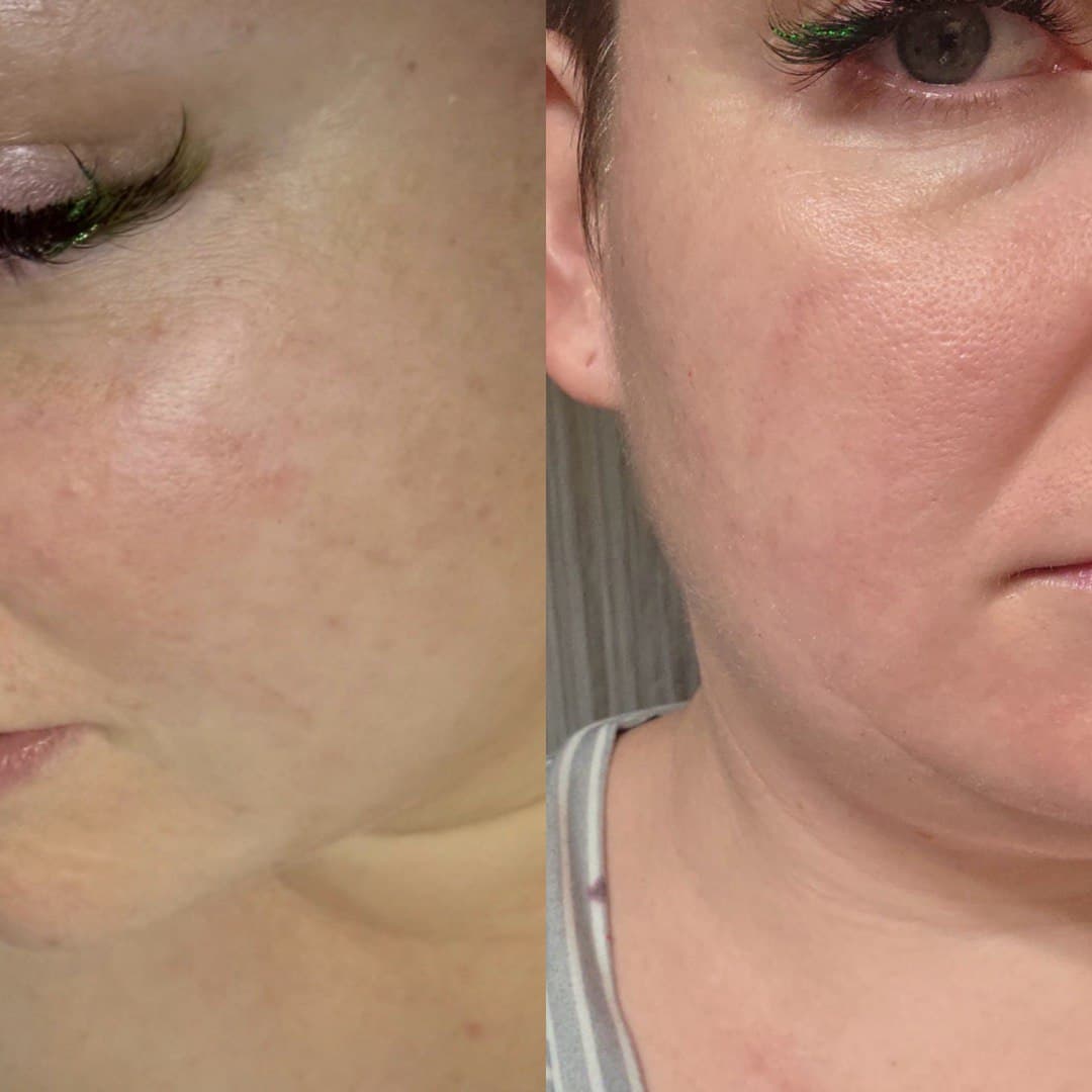 Chemical peel transformation: before photo showing uneven skin texture and tone; after photo taken after 3 treatments showing refined texture, improved clarity, and more even complexion